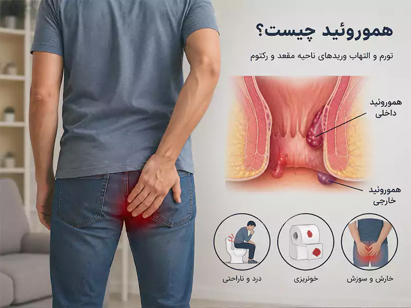 علائم هموروئید