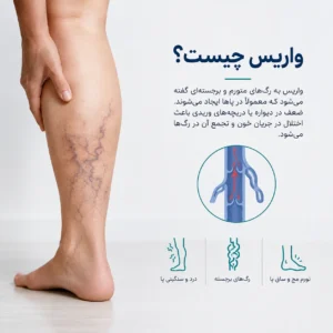 بیماری واریس