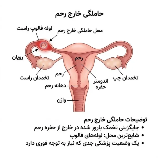 عمل حاملگی خارج رحمی