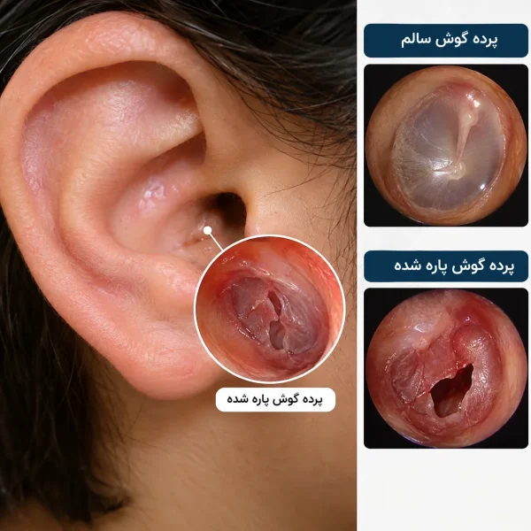 جراحی ترمیم پرده گوش